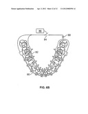 SYSTEMS AND METHODS FOR INTRA-ORAL DRUG DELIVERY diagram and image