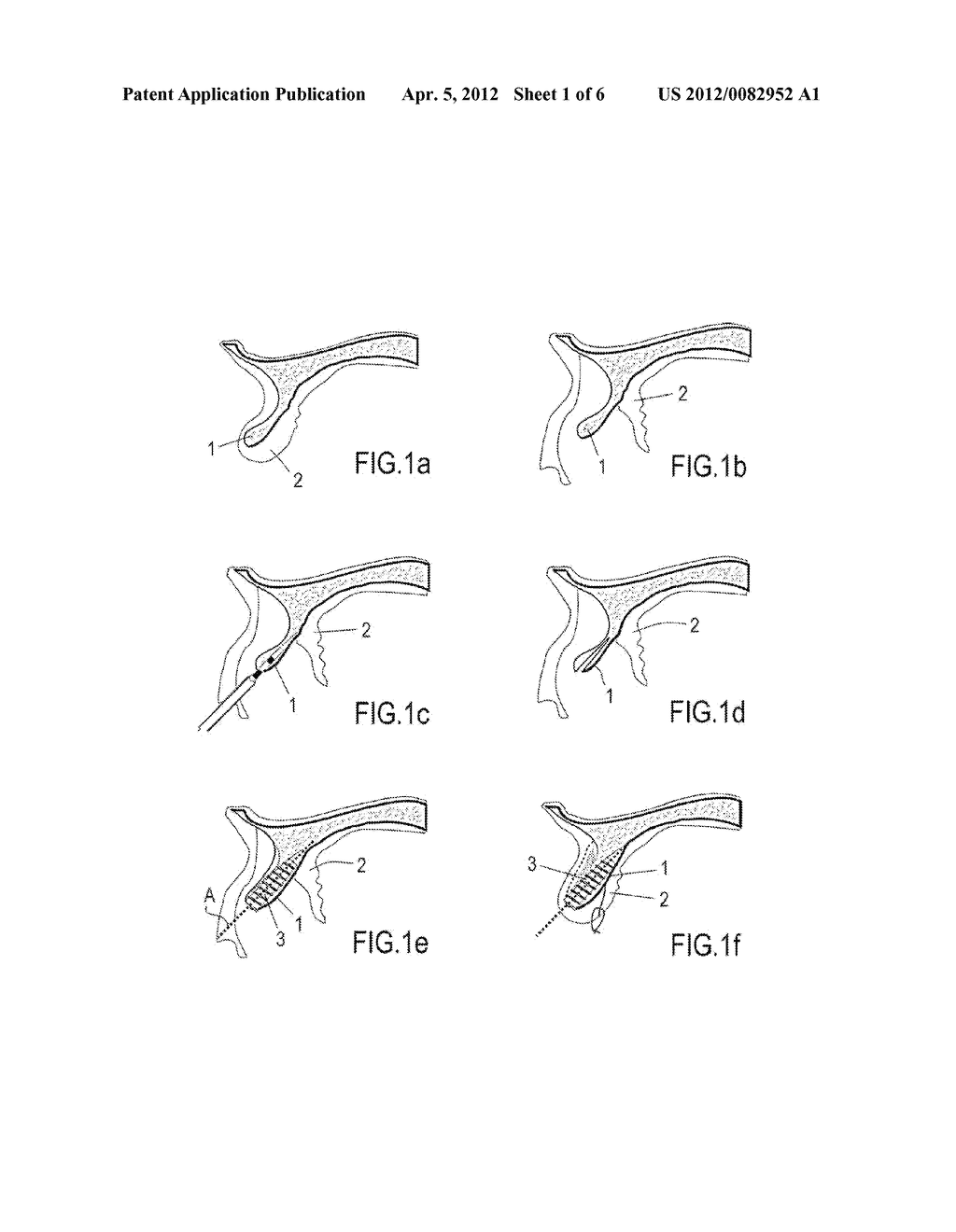 METHOD FOR EXPANDING BONE CREST AND AN IMPLANT-EXPANDER FOR USE IN SAID     METHOD - diagram, schematic, and image 02
