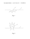 SURGICAL IMPLANT AND METHODS OF USE diagram and image