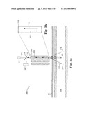 LIGHT-GUIDED TRANSLUMINAL CATHETER diagram and image