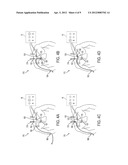 Method for Locating a Catheter Tip Using Audio Detection diagram and image