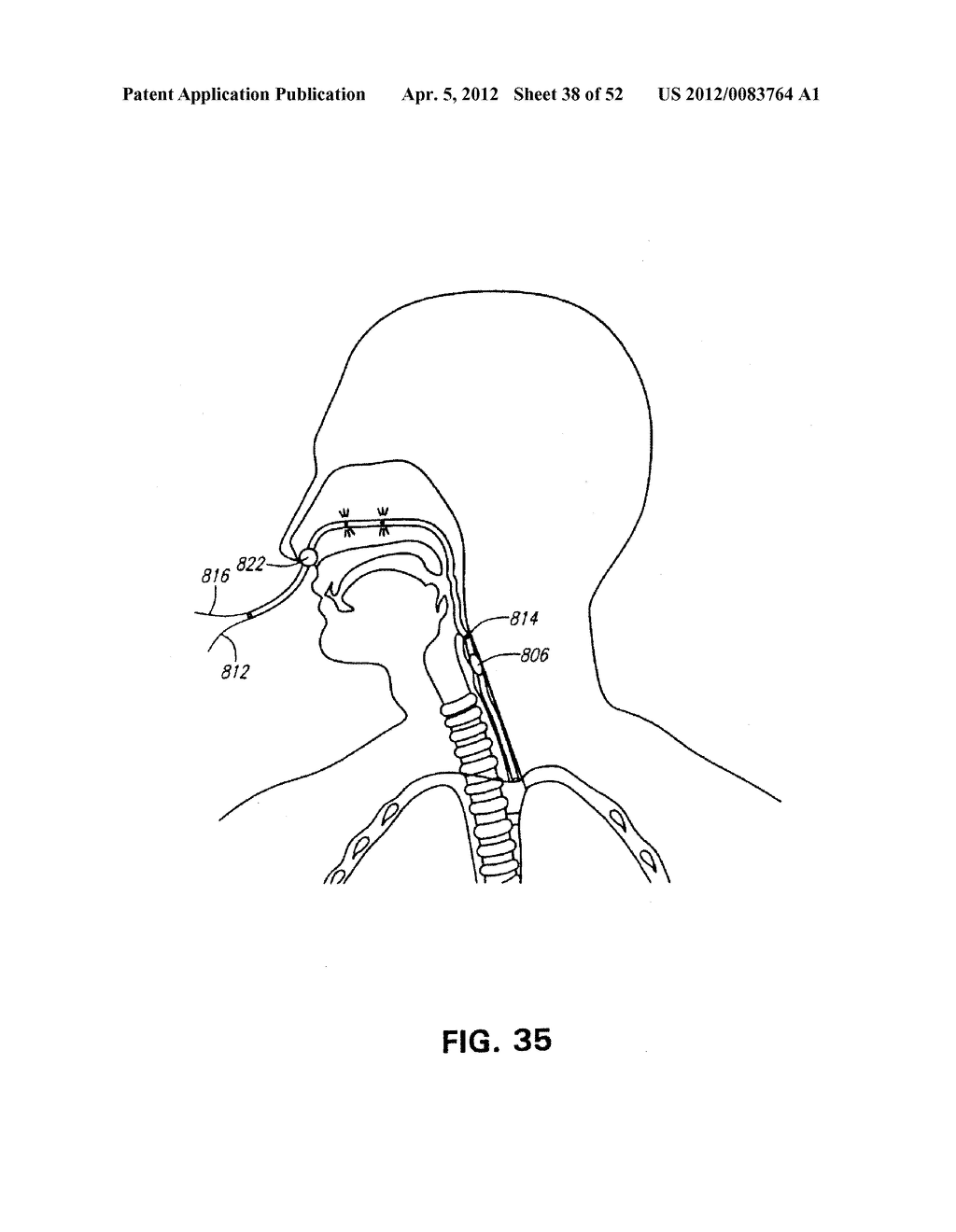 METHODS AND DEVICES FOR TREATMENT OF MIGRAINES - diagram, schematic, and image 39