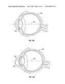 CORNEAL TREATMENT SYSTEM AND METHOD diagram and image