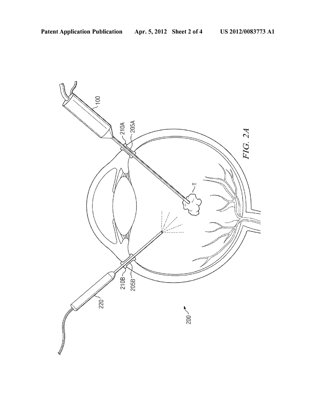 SMALL DIAMETER FRAGMATOME FOR MINIMALLY TRAUMATIC RETAINED LENS FRAGMENTS     REMOVAL - diagram, schematic, and image 03