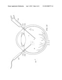 SMALL DIAMETER FRAGMATOME FOR MINIMALLY TRAUMATIC RETAINED LENS FRAGMENTS     REMOVAL diagram and image