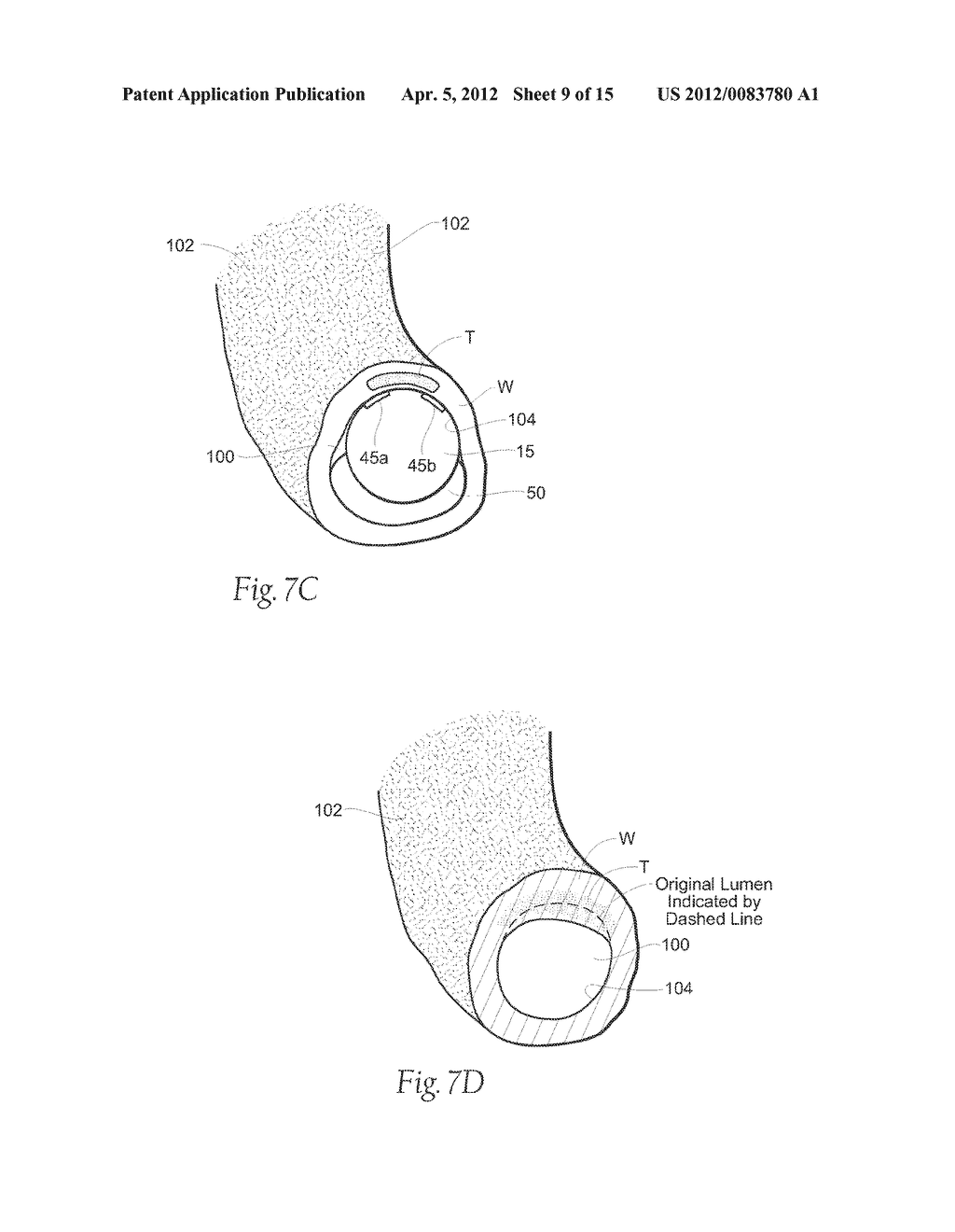 SURGICAL INSTRUMENTS AND TECHNIQUES FOR TREATING GASTRO-ESOPHAGEAL REFLUX     DISEASE - diagram, schematic, and image 10