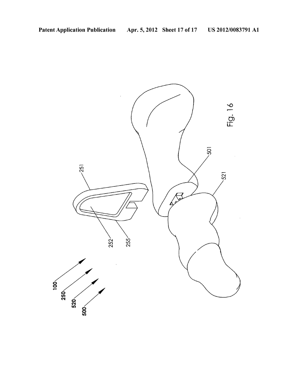 Method and system for storing and inserting an implant - diagram, schematic, and image 18