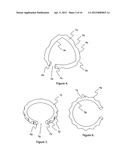 External scaffolds for expanding strictures in tubular organs and their     use diagram and image