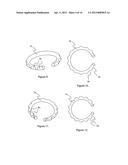 External scaffolds for expanding strictures in tubular organs and their     use diagram and image