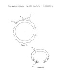 External scaffolds for expanding strictures in tubular organs and their     use diagram and image