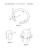 External scaffolds for expanding strictures in tubular organs and their     use diagram and image