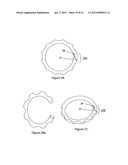 External scaffolds for expanding strictures in tubular organs and their     use diagram and image