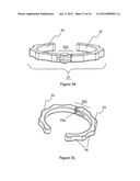 External scaffolds for expanding strictures in tubular organs and their     use diagram and image