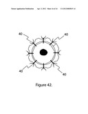 External scaffolds for expanding strictures in tubular organs and their     use diagram and image