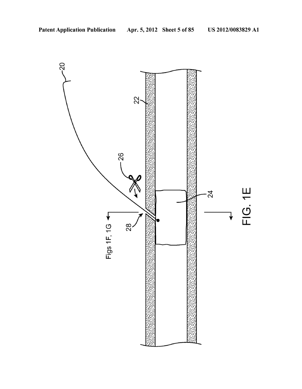 SYSTEM AND METHOD FOR VESSEL ACCESS CLOSURE - diagram, schematic, and image 06