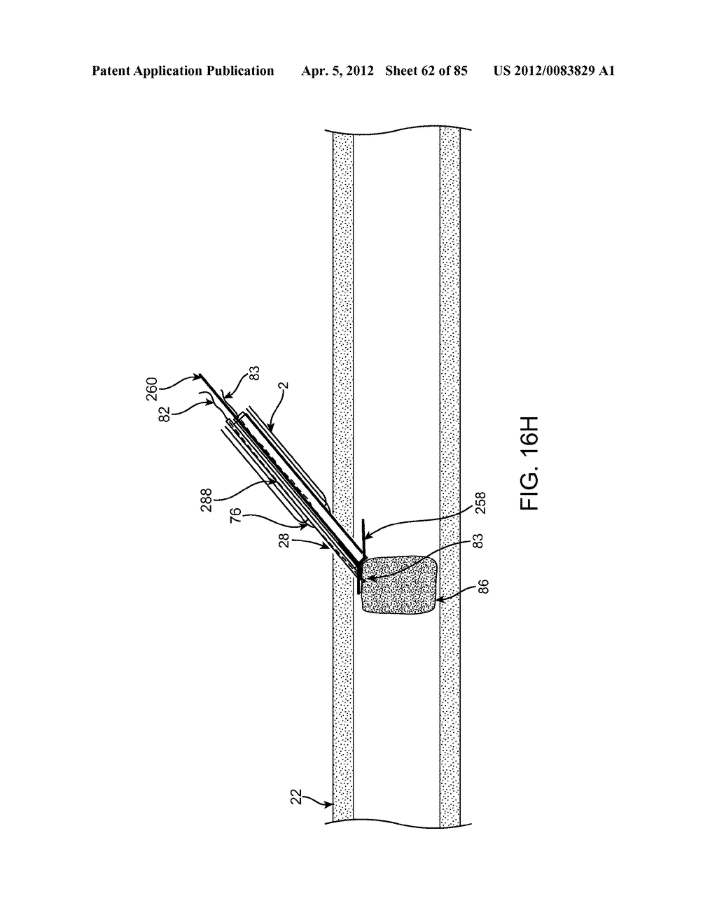 SYSTEM AND METHOD FOR VESSEL ACCESS CLOSURE - diagram, schematic, and image 63