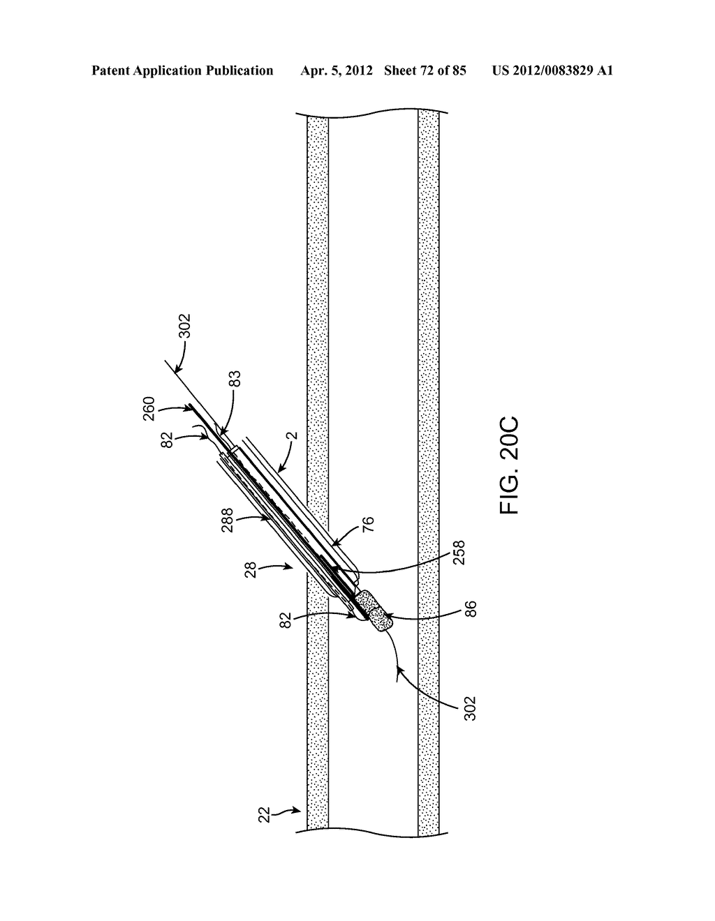 SYSTEM AND METHOD FOR VESSEL ACCESS CLOSURE - diagram, schematic, and image 73