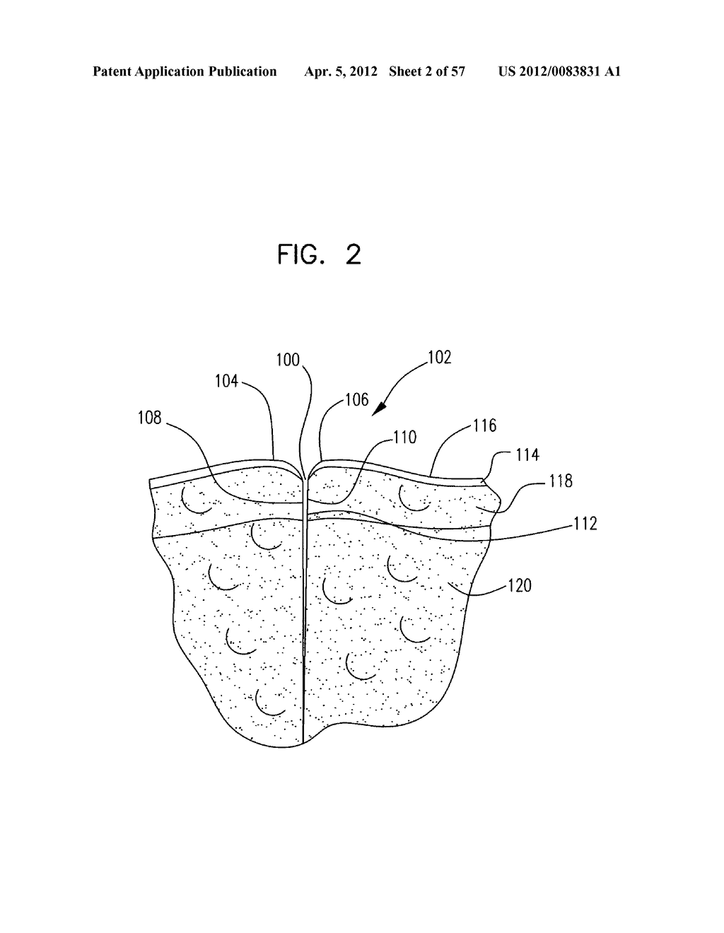 MECHANICAL METHOD AND APPARATUS FOR SEQUENTIAL TISSUE FASTENING - diagram, schematic, and image 03