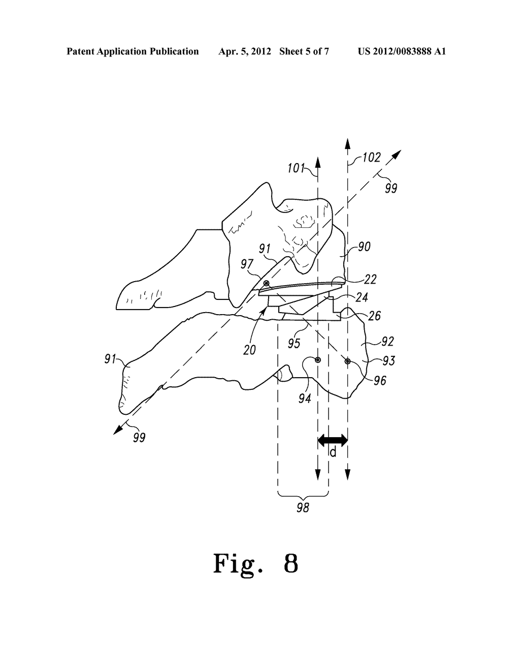 Disc Prosthesis having Remote Flexion/Extension Center of Rotation - diagram, schematic, and image 06