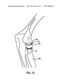 Modular Radial Head Prostheses diagram and image