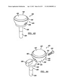 Modular Radial Head Prostheses diagram and image