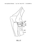 Modular Radial Head Prostheses diagram and image