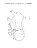 ARTERIAL DEVICE, SYSTEM AND METHOD diagram and image