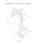 ARTERIAL DEVICE, SYSTEM AND METHOD diagram and image