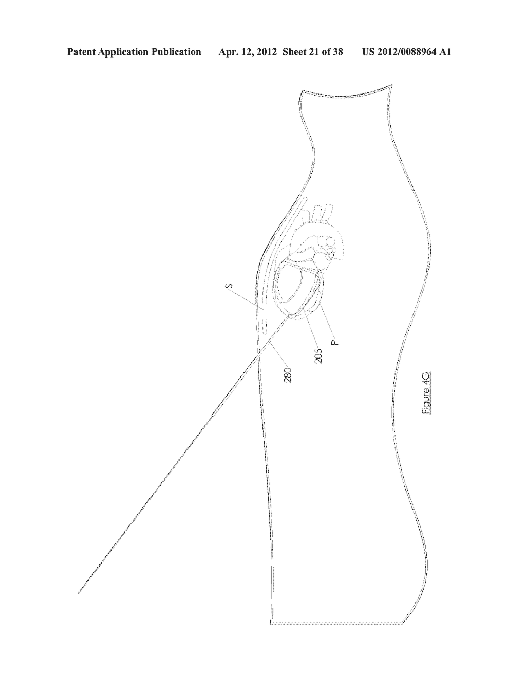 Methods and devices for pericardial access - diagram, schematic, and image 22