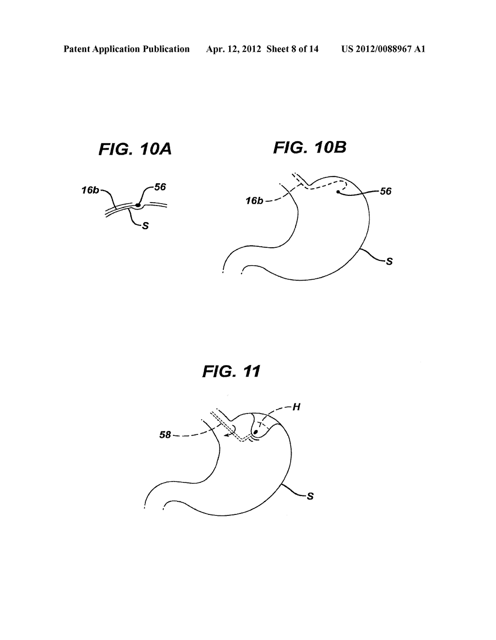 Methods and Devices for Placement of an Intra-Abdominal or Intra-Thoracic     Appliance Through a Natural Body Orifice - diagram, schematic, and image 09