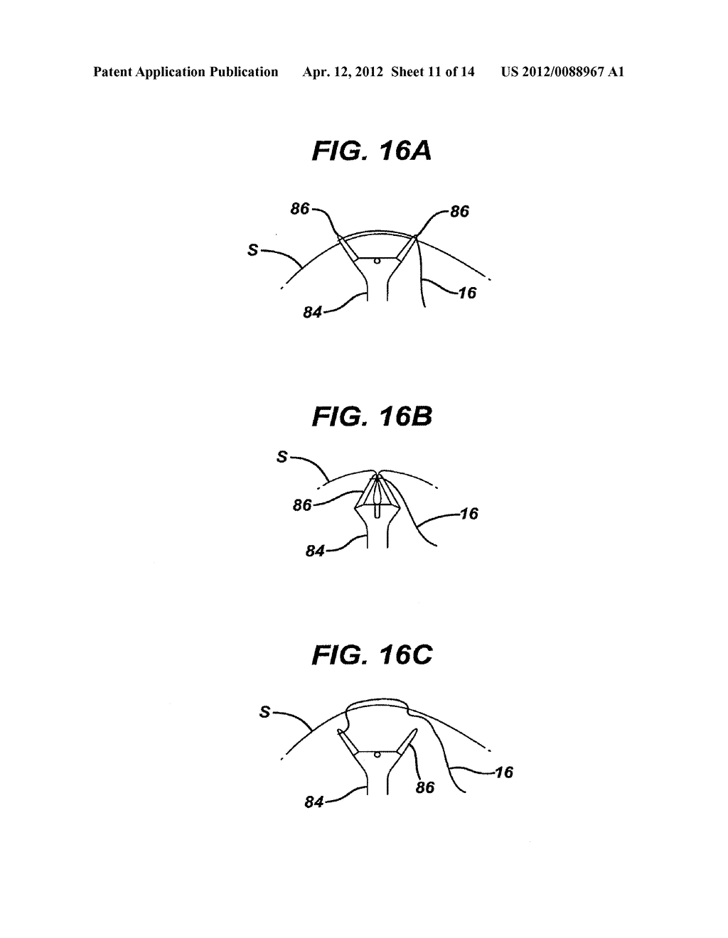 Methods and Devices for Placement of an Intra-Abdominal or Intra-Thoracic     Appliance Through a Natural Body Orifice - diagram, schematic, and image 12