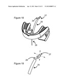 ROTICAM: An Orotracheal Guide with Camera diagram and image