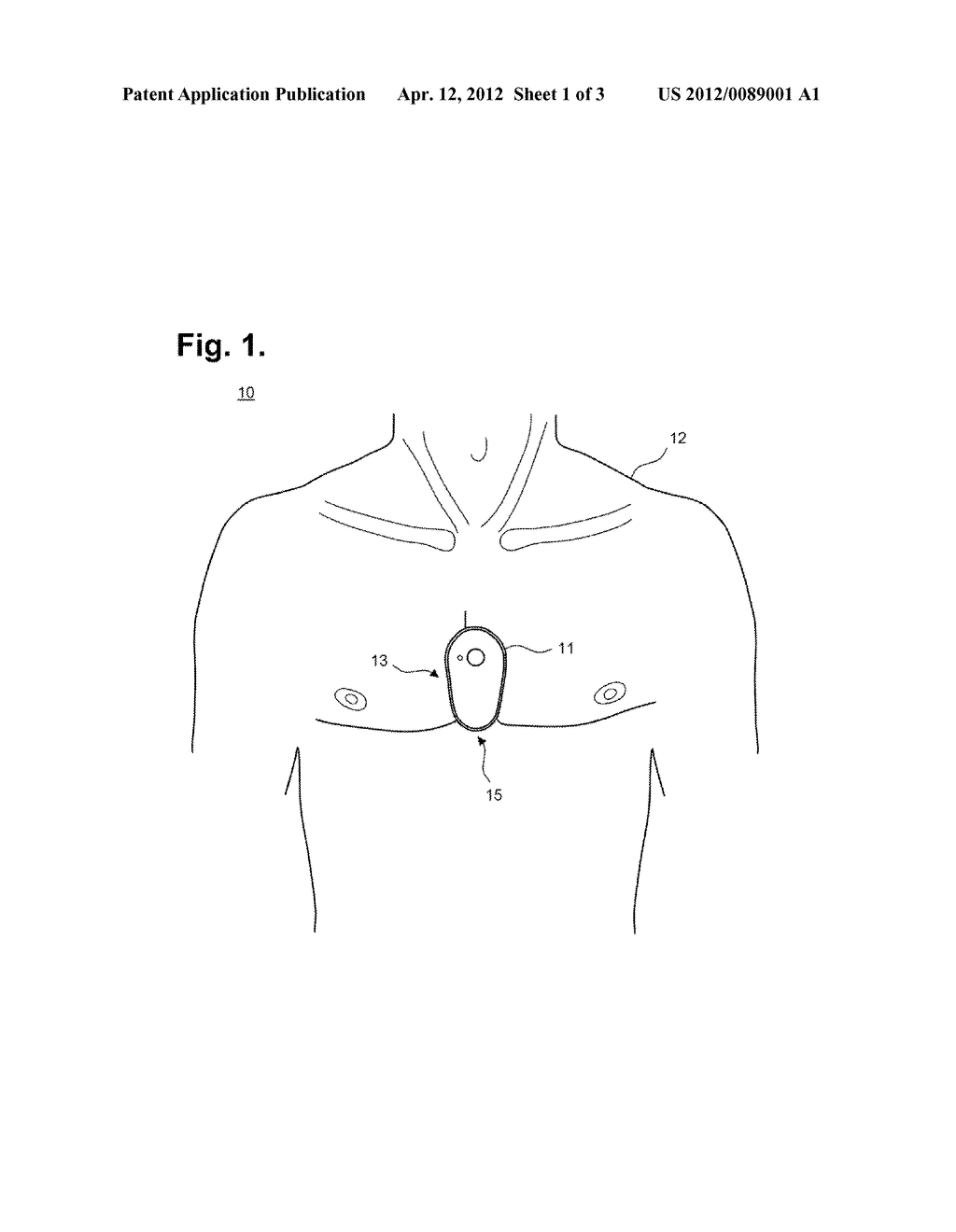 Ambulatory Electrocardiographic Monitor And Method Of Use - diagram, schematic, and image 02