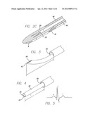 Reduction of Recirculation in Catheters diagram and image