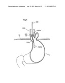 STOMACH INSTRUMENT AND METHOD diagram and image