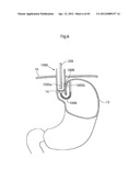 STOMACH INSTRUMENT AND METHOD diagram and image