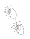 STOMACH INSTRUMENT AND METHOD diagram and image