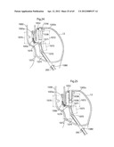 STOMACH INSTRUMENT AND METHOD diagram and image