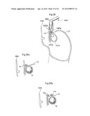 STOMACH INSTRUMENT AND METHOD diagram and image