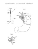 STOMACH INSTRUMENT AND METHOD diagram and image