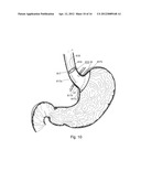 BARIATRIC DEVICE AND METHOD diagram and image