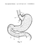 BARIATRIC DEVICE AND METHOD diagram and image