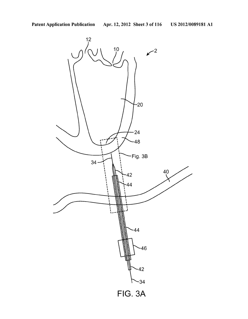 METHOD FOR PROVIDING SURGICAL ACCESS - diagram, schematic, and image 04