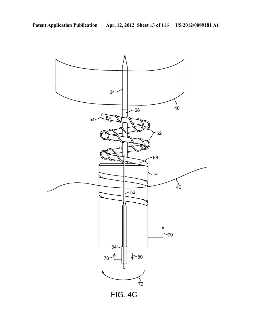 METHOD FOR PROVIDING SURGICAL ACCESS - diagram, schematic, and image 14