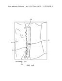 METHOD FOR PROVIDING SURGICAL ACCESS diagram and image