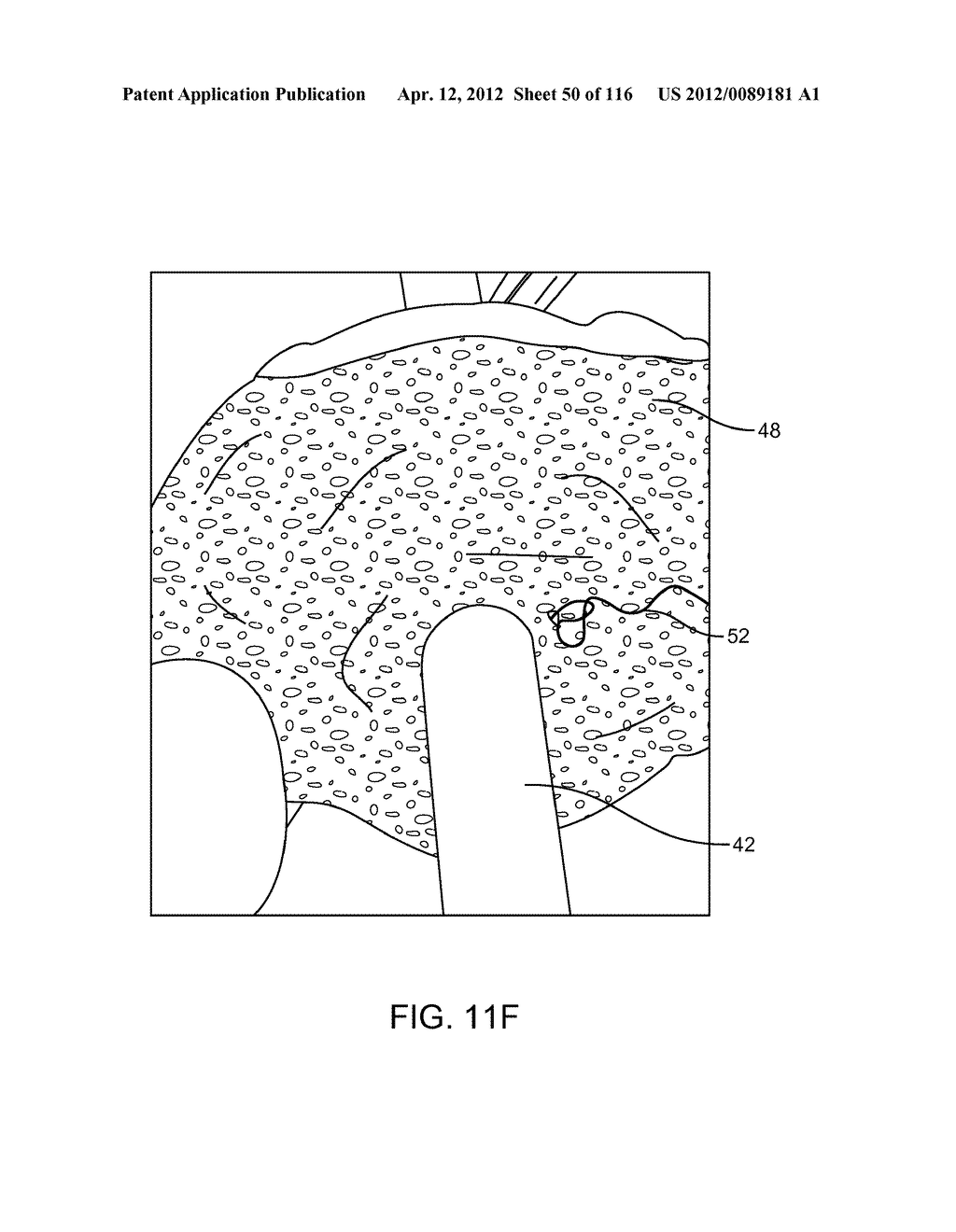 METHOD FOR PROVIDING SURGICAL ACCESS - diagram, schematic, and image 51