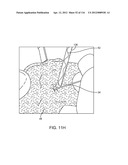 METHOD FOR PROVIDING SURGICAL ACCESS diagram and image