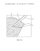 METHOD FOR PROVIDING SURGICAL ACCESS diagram and image