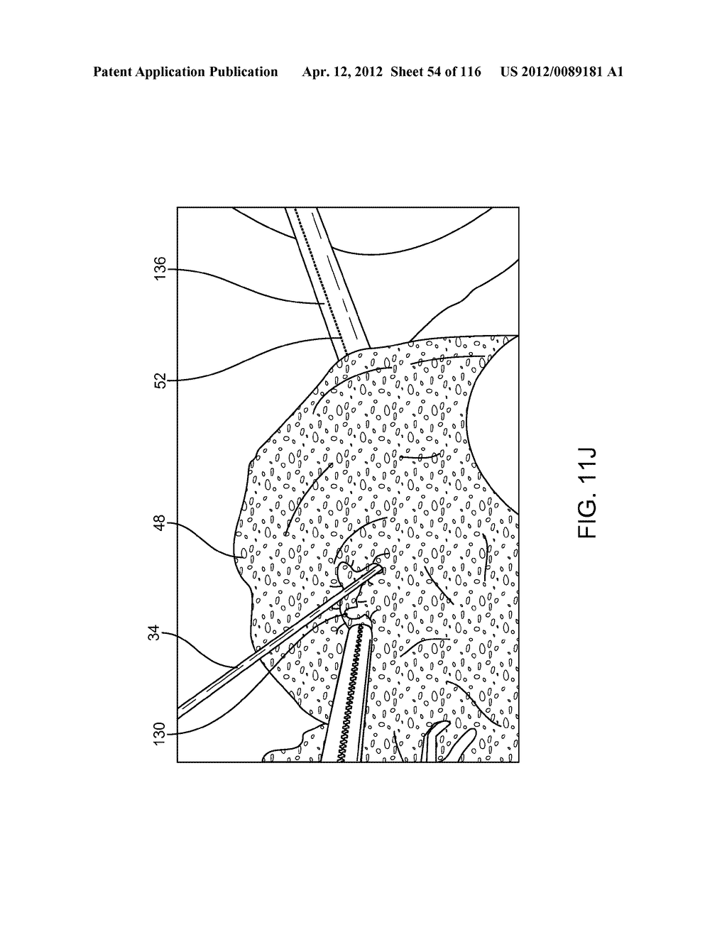 METHOD FOR PROVIDING SURGICAL ACCESS - diagram, schematic, and image 55