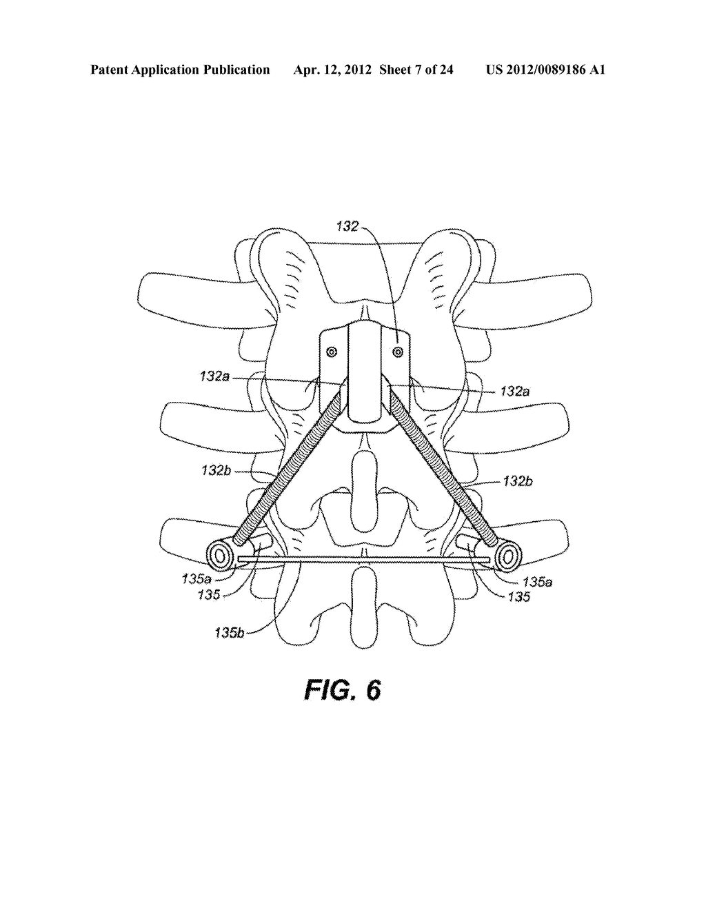 DEVICE AND METHOD FOR CORRECTING A SPINAL DEFORMITY - diagram, schematic, and image 08